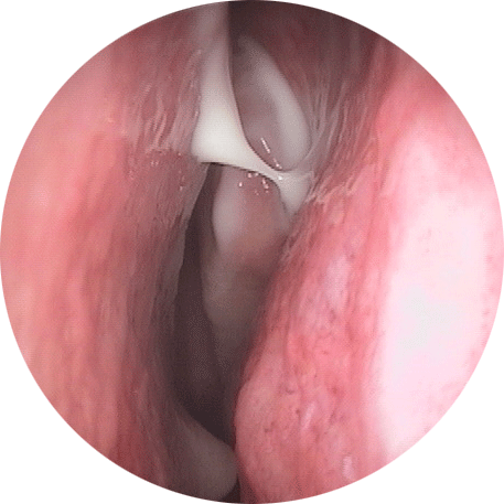 副鼻腔炎・後鼻漏を早く治すためのセルフケア3選 - 瑞穂区の名古屋はなまる耳鼻科クリニック日曜日も診療してる耳鼻咽喉科