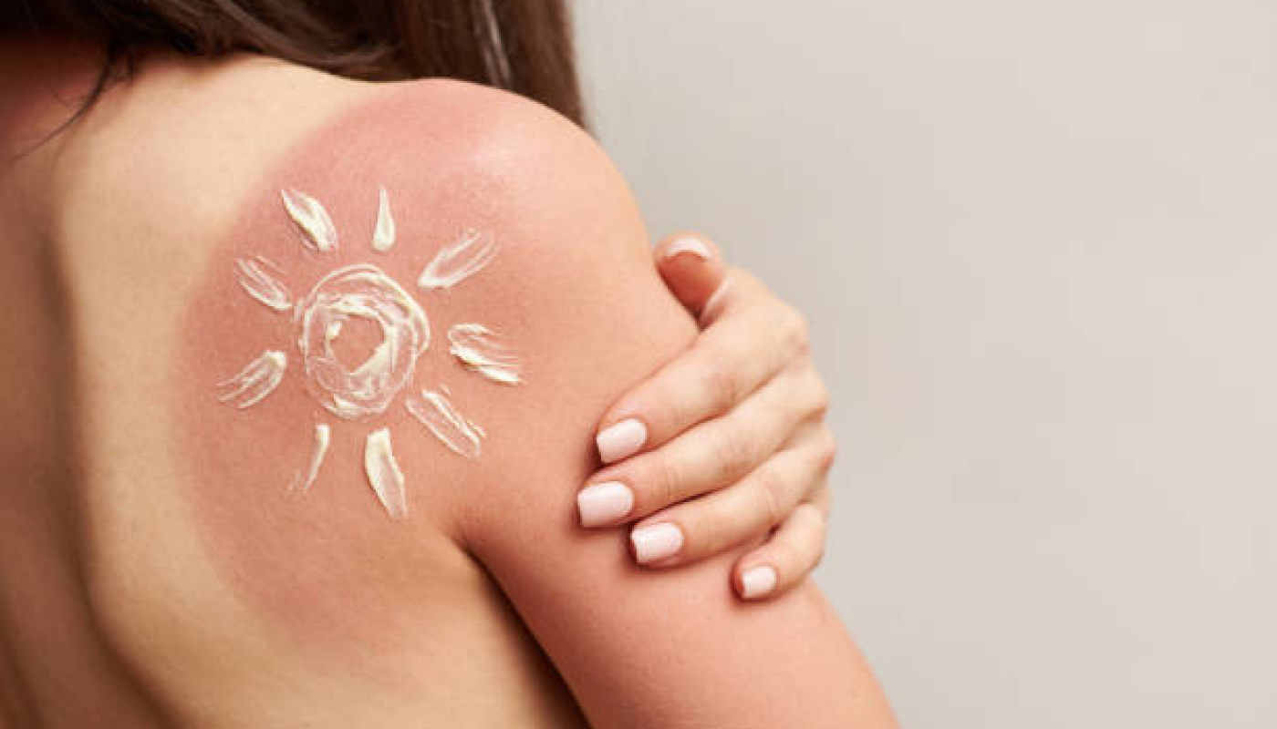 日焼けで皮が剥けたときにするべき8つのこと