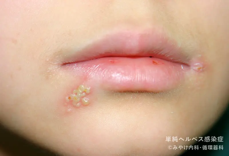 赤ちゃんの皮膚の病気 単純ヘルペスの症状とケア 医師監修 たまひよ