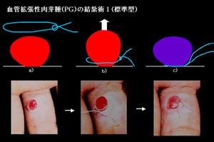 褥瘡：日経メディカル