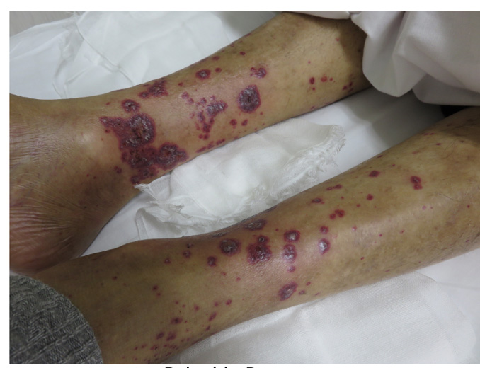 掌蹠膿疱症 しょうせきのうほうしょう の原因と症状・治療吹田市・江坂のたまき皮フ科