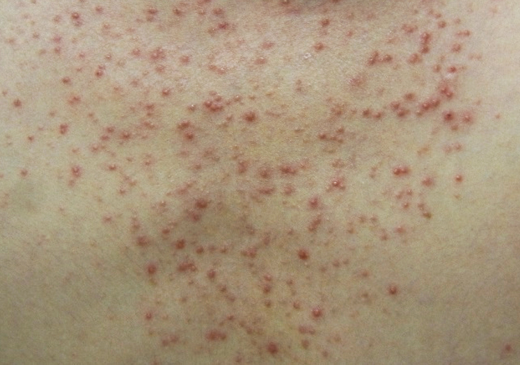 クリニックブログ岡山市南区の皮膚科うちだ皮膚科クリニックヘルペス・とびひ・乾癬・アトピー性皮膚炎など