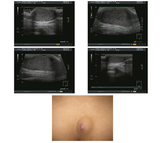 顎下部に生じた脂肪腫の１例