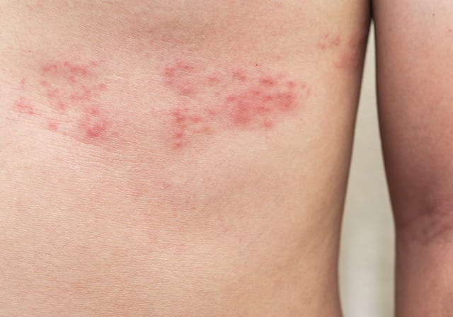 帯状疱疹はうつる？子供、大人、高齢者での感染リスクと予防策についてひまわり医院 内科・皮膚科