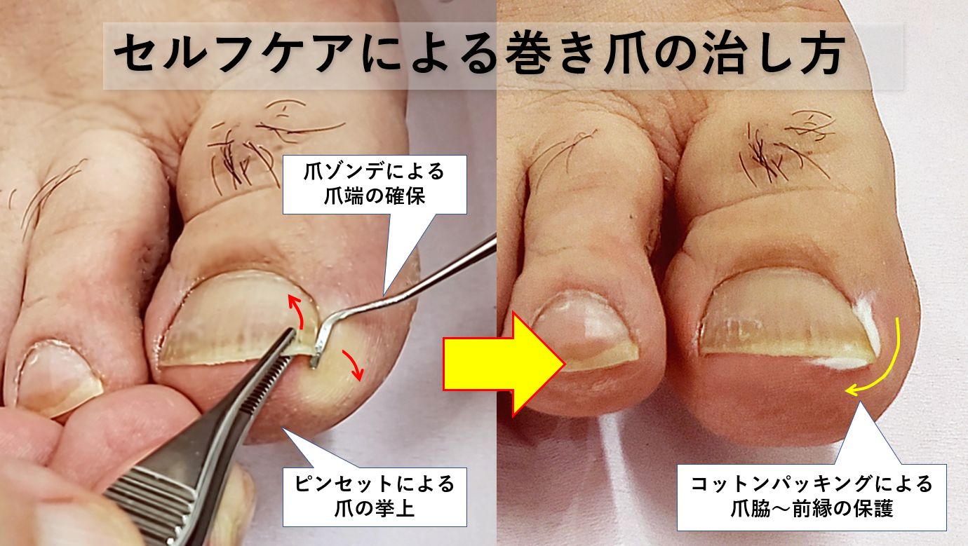 ご家庭でできるフットケア│爪切り屋 メディカルフットケアＪＦ協会監修「家族のフットケア」