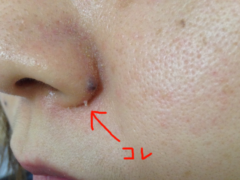 角質培養4ヶ月め 角栓とモサをカット - 角質培養成功への記録