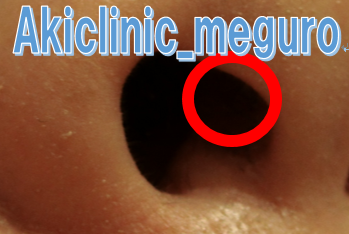 鼻の中のできものが痛い」時の対処法はご存知ですか？医師が徹底解説！ 症状の原因・病気一覧・診療科 - メディカルドック