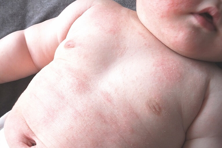 助産師監修 赤ちゃんのあせも対策完全ガイド原因・ケア・病院に行く目安まで- キッズライン