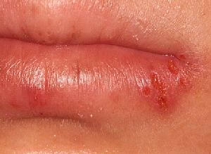 口唇ヘルペスと口内炎の違いとは？見分け方と対処法を解説 - 国立駅徒歩3分の歯医者、国立深澤歯科クリニック 国立市
