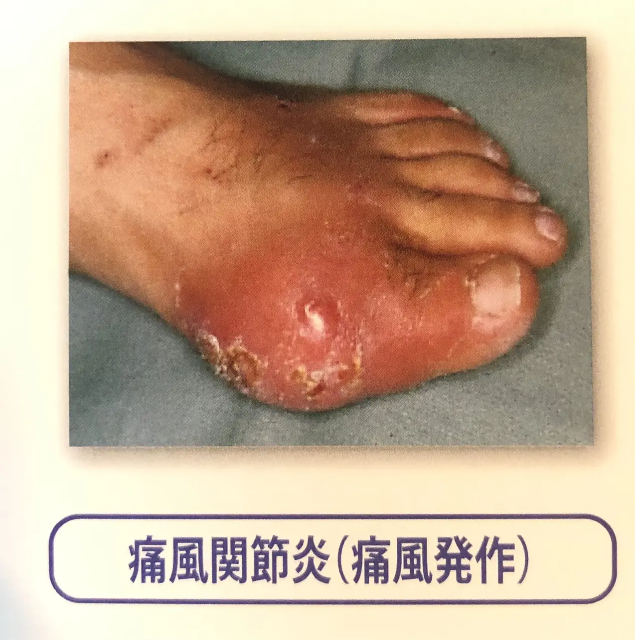 痛風 - 武蔵小杉整形外科 川崎市中原区