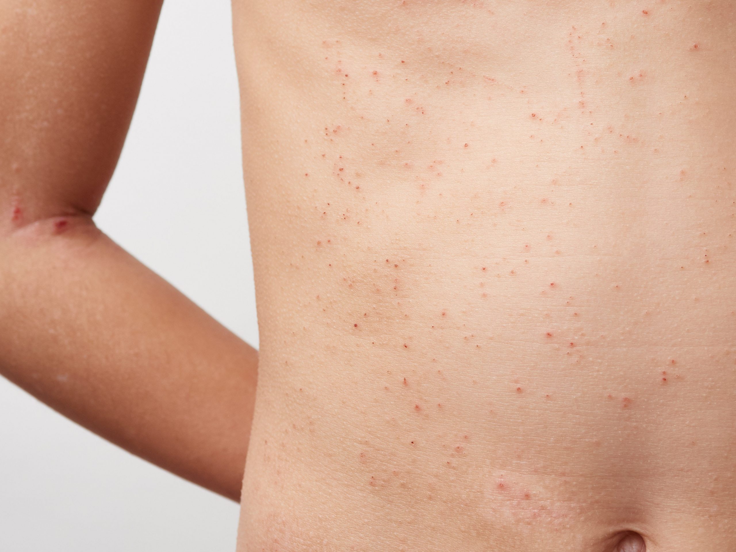 あせも 汗疹 治し方・原因・症状・対処法・予防法大正健康ナビ大正製薬