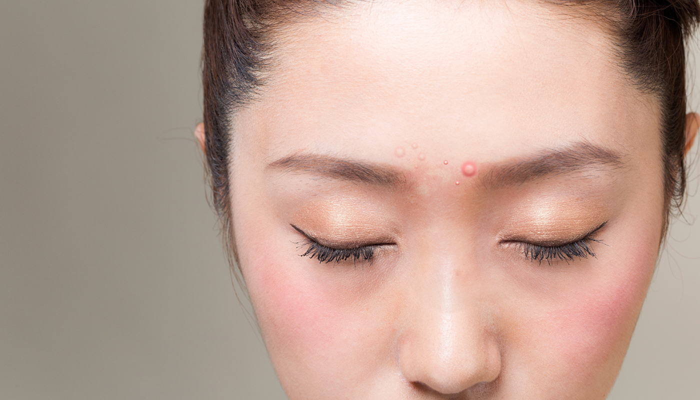 肌荒れ ニキビ・跡阿倍野・天王寺の自律神経失調症の鍼灸外来ならARSはりハウス施術家歴19年