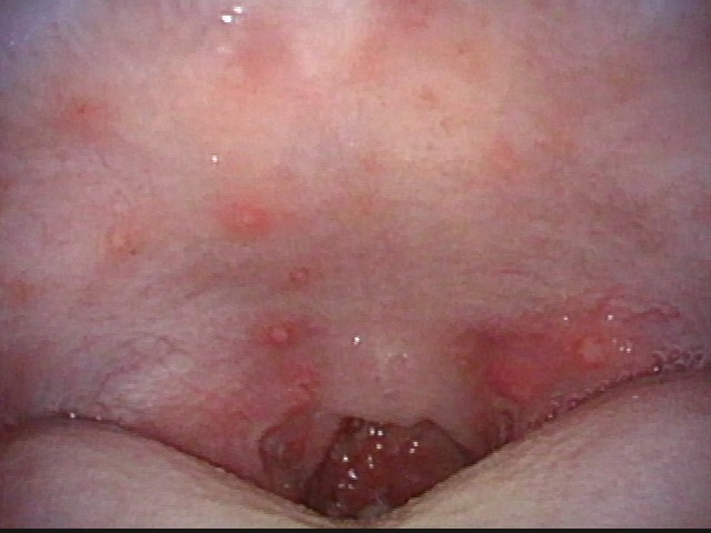 手足口病とヘルパンギーナについて東京都世田谷区の耳鼻咽喉科 外科 内科「はたのクリニック」