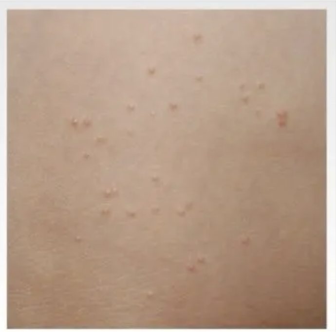 胸、背中、二の腕ぶつぶつは治りにくいニキビ？ではなくマラセチア毛包炎かも・背中 ニキビ難治性ニキビあゆ皮フ科クリニック高槻市の一般皮膚科・小児皮膚科・皮膚外科・美容皮膚科