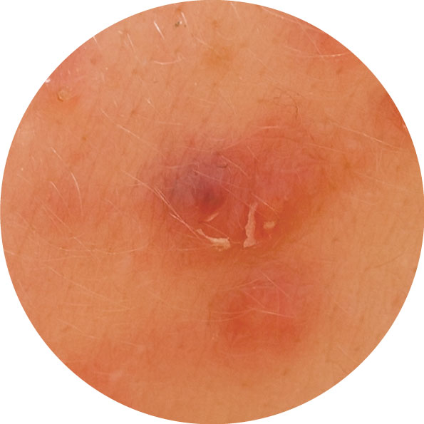 毛嚢炎 毛包炎イシャチョク