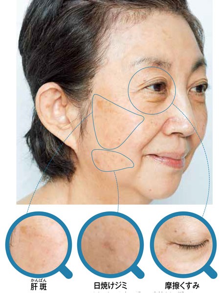 40代でもシミがない人の特徴は？ できやすいシミの種類やシミ対策を解説 - Otsuka Pharmaceutical Co., Ltd