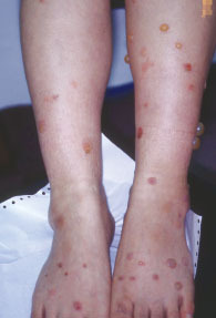 虫刺され茨城県古河市古河いけがき皮膚科皮膚科・美容皮膚科