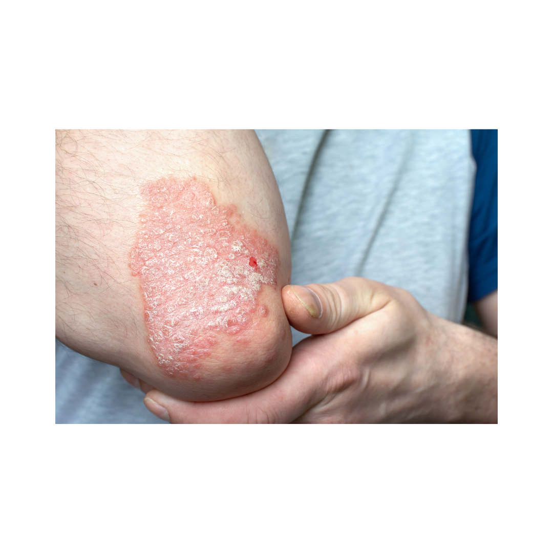 乾癬の種類乾癬パートナーズ