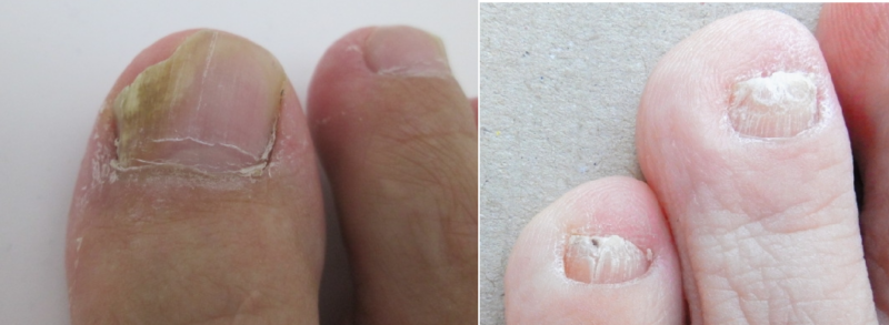 水虫・爪白癬の治療足の痒み、爪の濁りに 南草津皮フ科