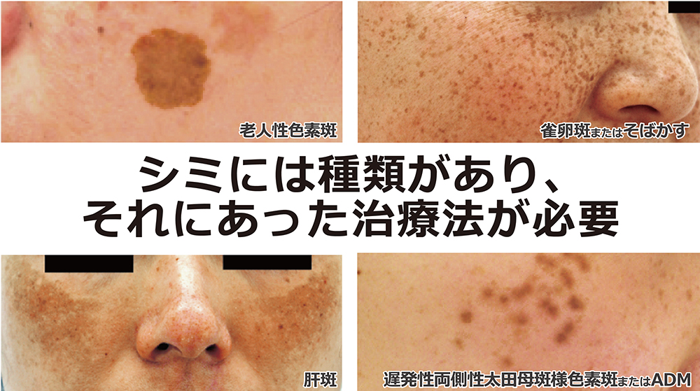 え！？シミが盛り上がってきた。これって本当にシミなの？治療法教えます - ブライツ美容クリニック