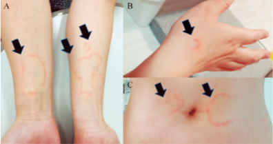 松下 ER ランチ・カンファレンス: 遺伝性血管性浮腫 HAEhereditary angioedema