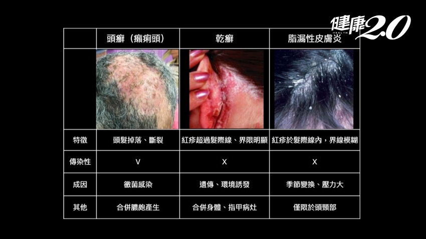 乾癬治療記乾癬の治療方法乾癬.comマルホ株式会社