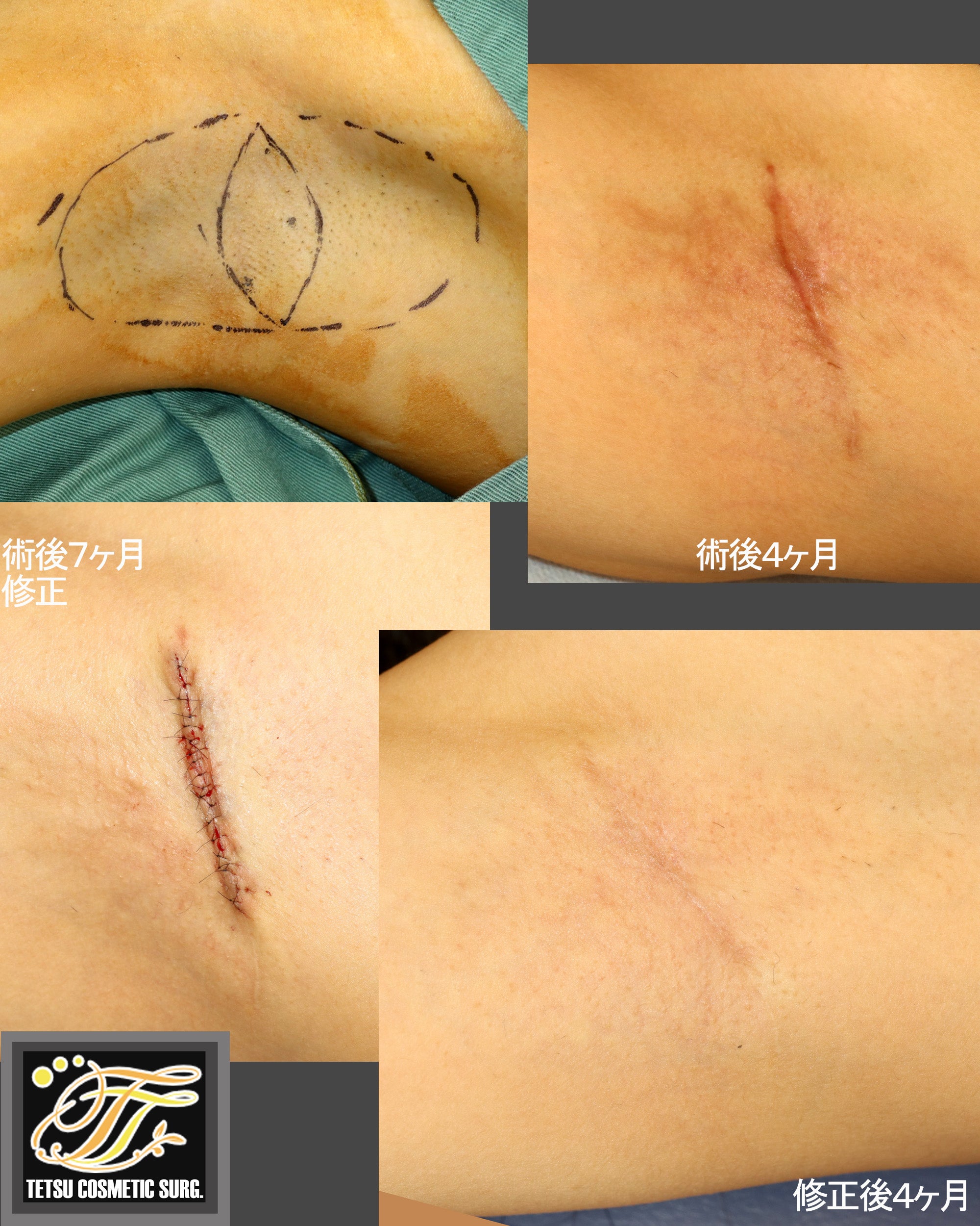 えぬくりブログ: 腋臭症 わきが