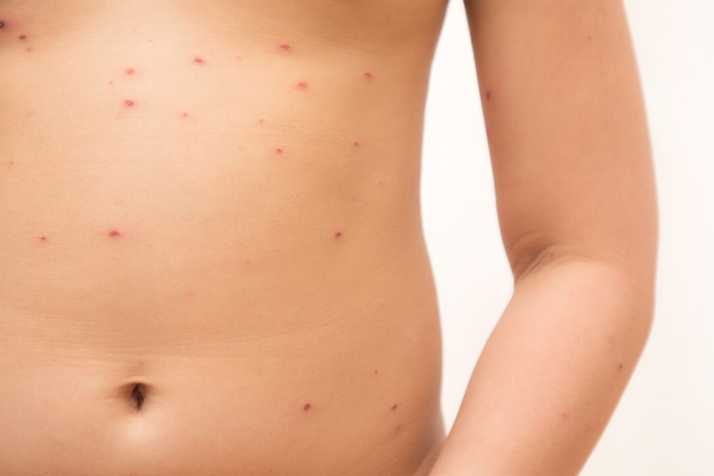 水ぼうそう 水痘- 巣鴨千石皮ふ科