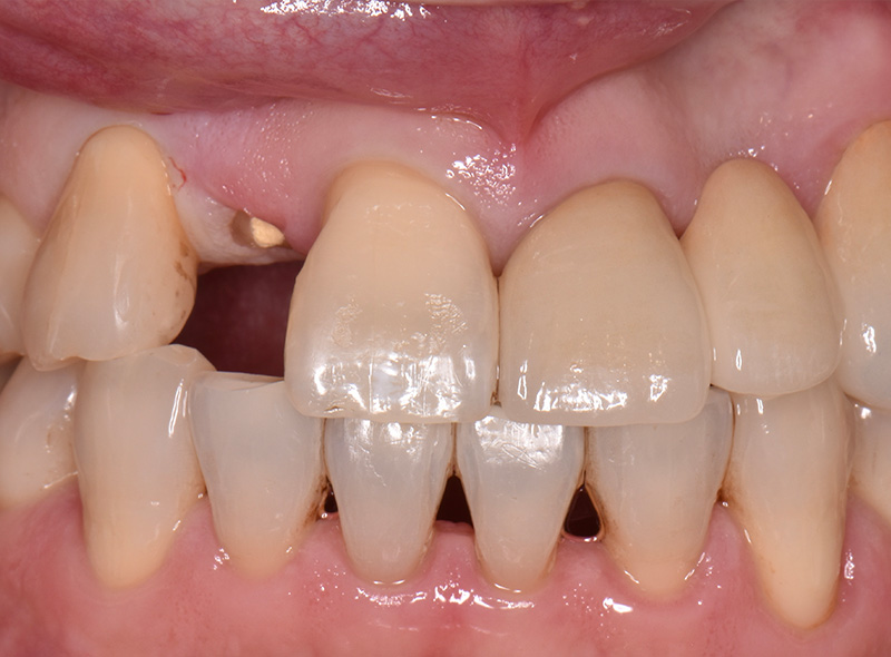 前歯をほとんど失った場合のインプラント症例インプラントネット