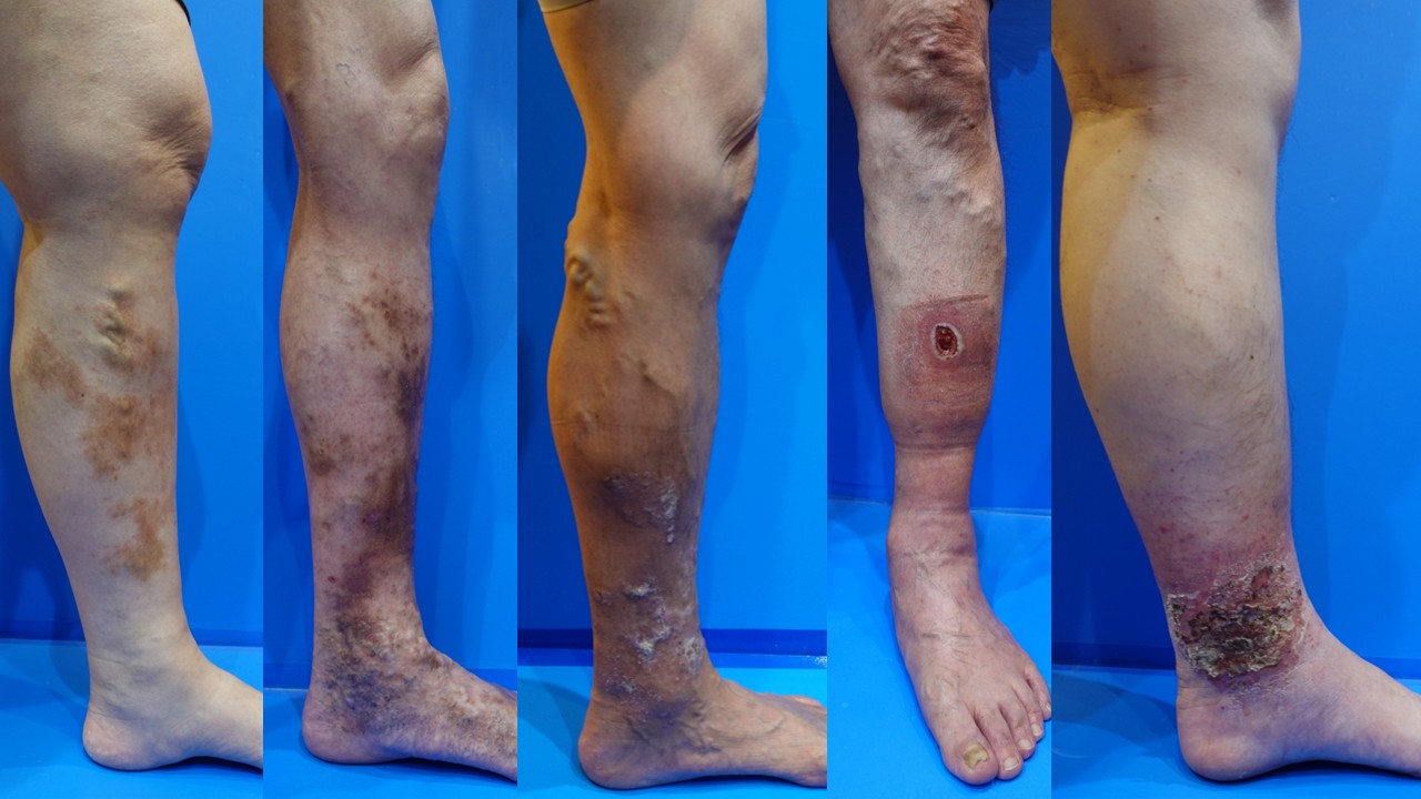 医師監修 妊娠中～産後に気になるむくみ 浮腫今すぐできる改善テク＆予防法 たまひよ