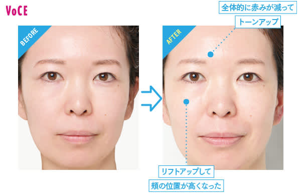 フォトフェイシャル M22 +エレクトロポレーション フェルズクリニック