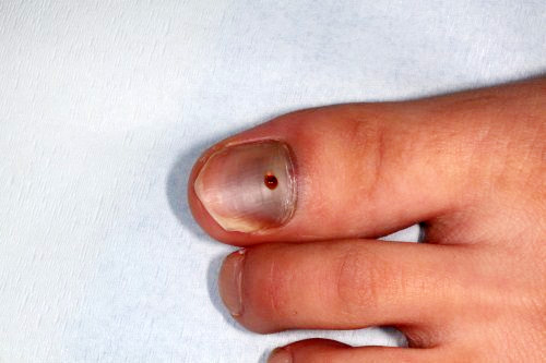爪下血腫」とはどのような症状ですか？ 爪下血腫