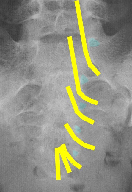 仙骨裂孔 - e-Anatomy - IMAIOS
