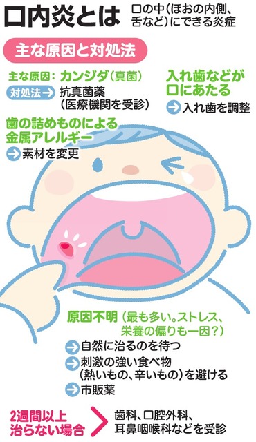 口内炎の診断・治療 - 新谷悟の歯科口腔外科塾