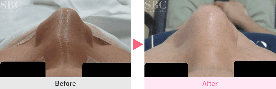 外傷性斜鼻 他院術後の段鼻・低鼻の修正 20代男性 症例No.29Y071941樹のひかり形成外科・皮ふ科 奈良 美容整形・美容皮膚科クリニック