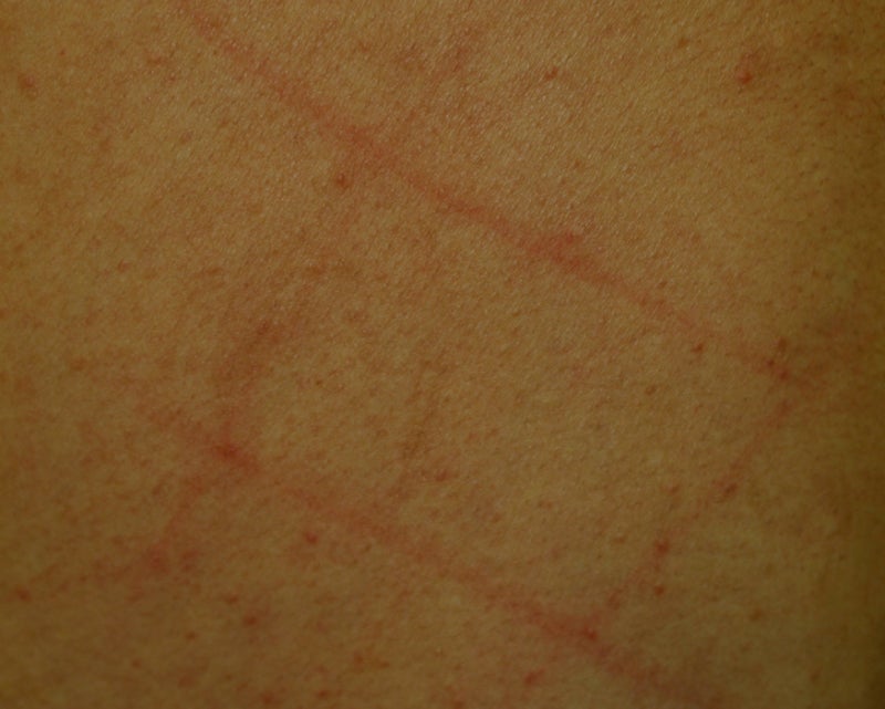 蕁麻疹の治し方はある？原因や控える食べ物について解説横浜内科・在宅クリニック