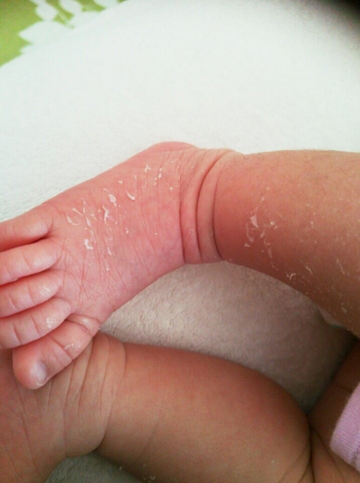 手足の皮がむける。 - もう40代 の、シングルマザーみなみの日記