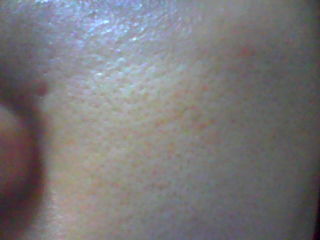 5分で分かる角質培養鼻の毛穴の黒ずみつまりに本当に効く対策とは