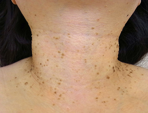 首のイボは液体窒素で取る？いぼの種類とやってはいけない取り方