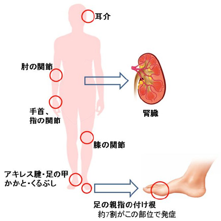 これでわかる！痛風教室痛風・人工透析なら東京都墨田区の両国東口クリニック