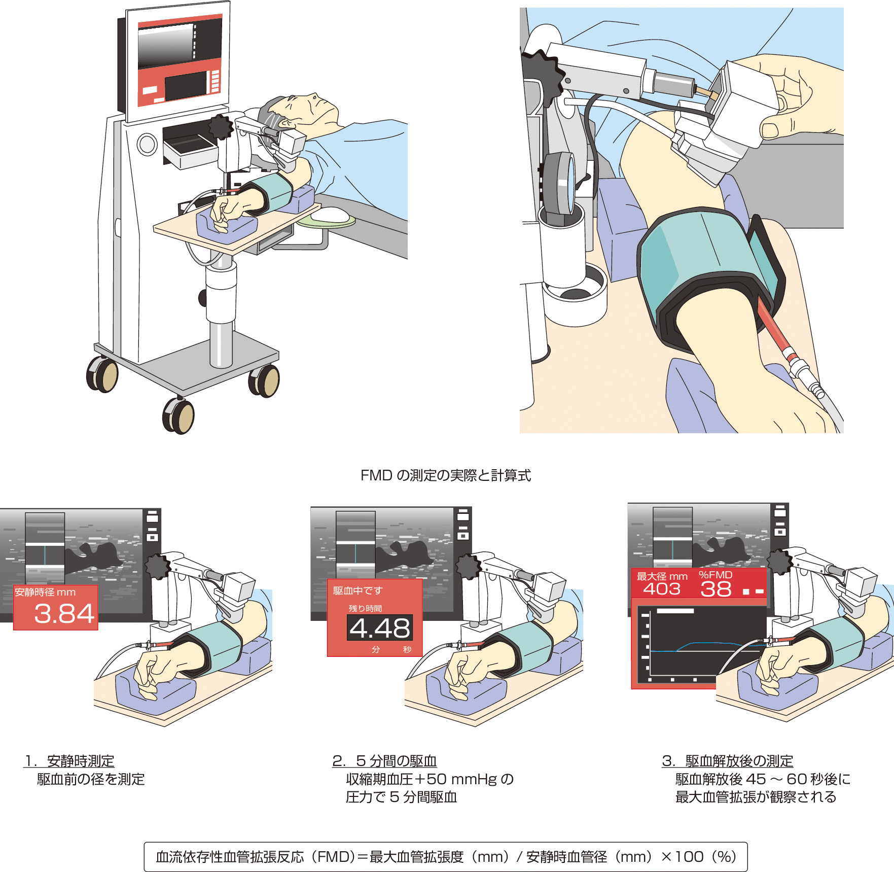 内頸動脈・後交通動脈分岐部漏斗状拡張を思わせる小動脈瘤破裂の2例Neurological Surgery 脳神経外科 8巻6号医書.jp