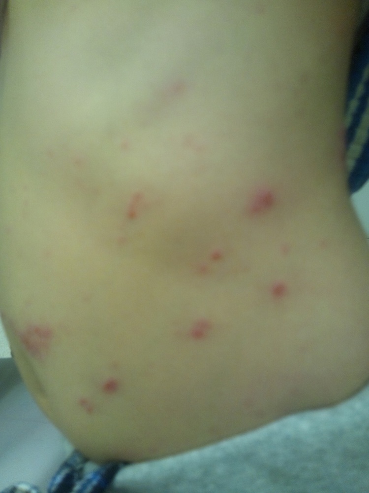 帯状疱疹？」鎖骨の赤い湿疹が日に日に悪化。実母の指摘で思い出した友人の地獄の痛み熟女系 94│40代50代女性のお悩み解決ウーマンカレンダ