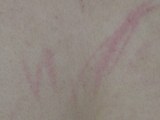 蕁麻疹と多形滲出性紅斑写真で見る「子どもの病気」 - みやけ内科・循環器科 総合内科のアプローチ