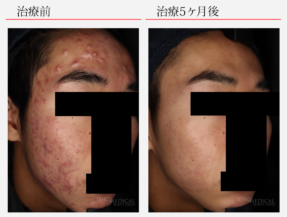 頭皮にできものができて触ると痛痒いです - なんですかこれはなんて言う病- Yahoo!知恵袋