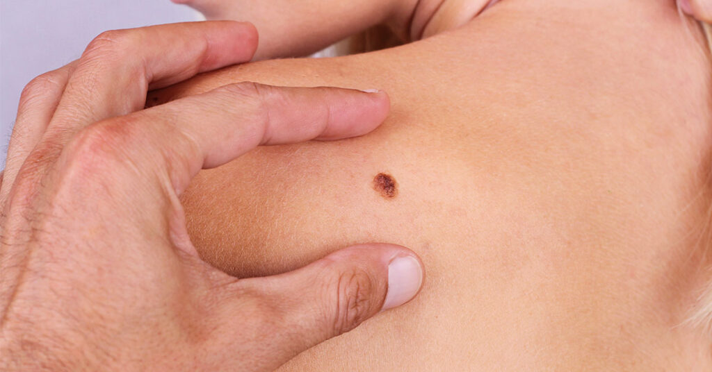 皮膚がんとほくろ ホクロ の見分け方は？悪性腫瘍との違いや検査・治療方法を解説マイクロCTC検査