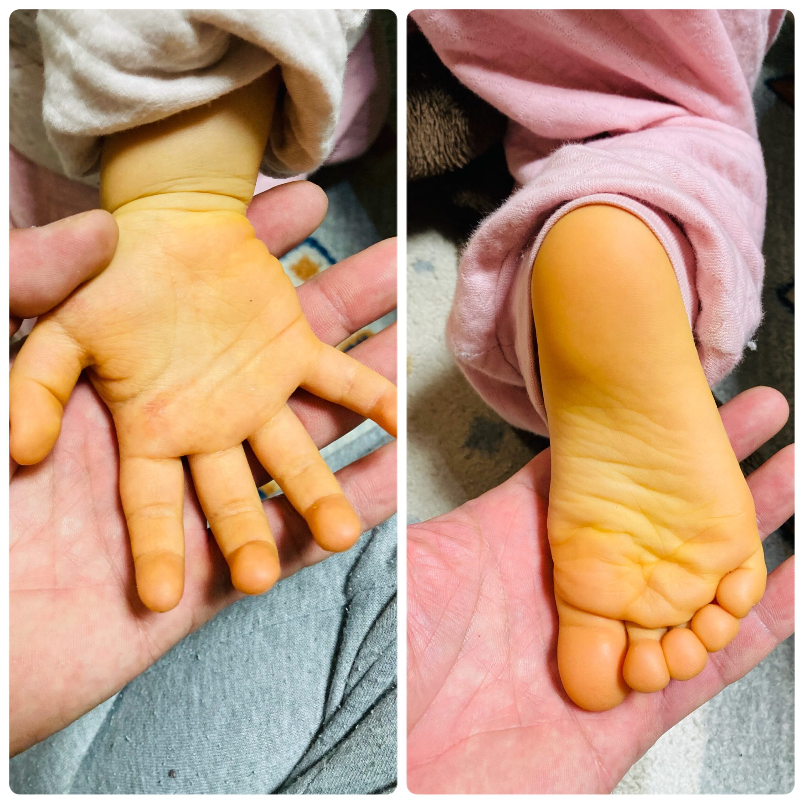 寒いと指が白くなる｢レイノー現象｣の原因・治療やなぎさわ皮フ科内科