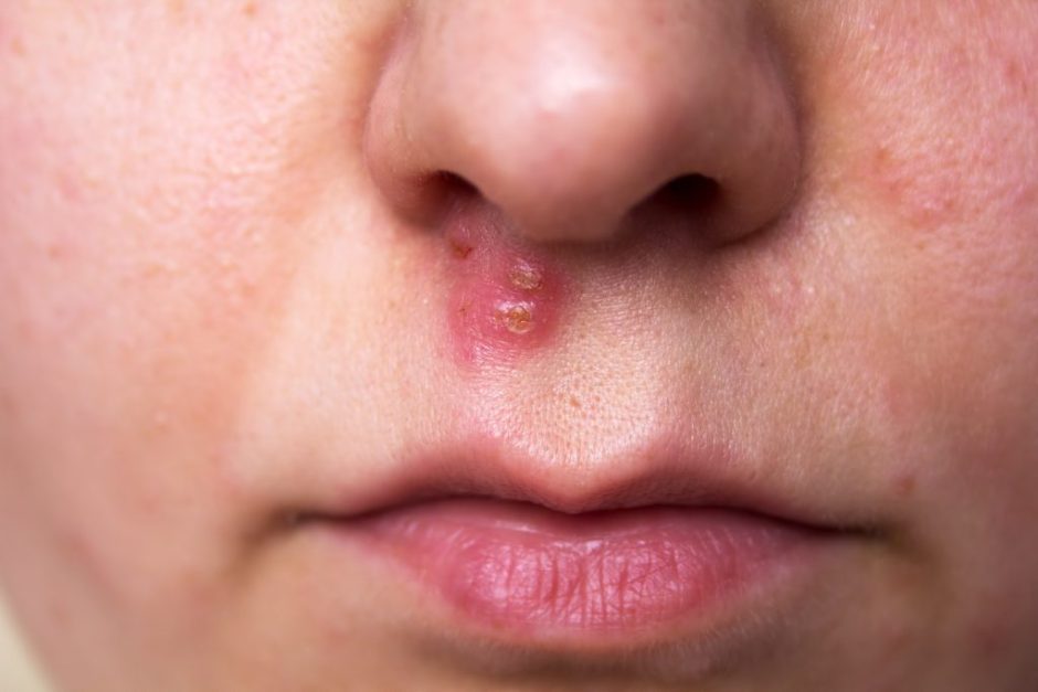 それって本当にニキビ？鼻にできたデキモノの正体について解説ニキビ・ニキビ跡治療のKM新宿クリニック