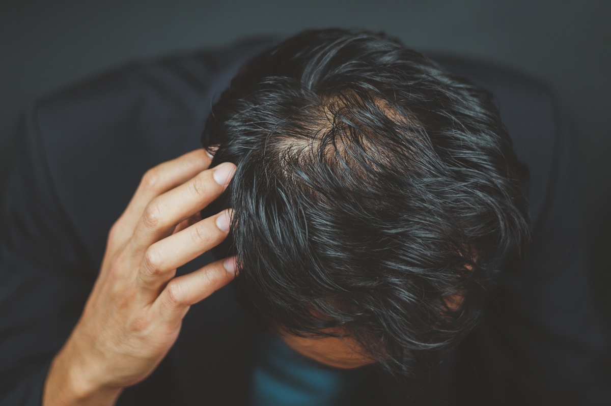 つむじはげの基準はどこから？頭頂部の薄毛の原因と治し方を専門医が解説