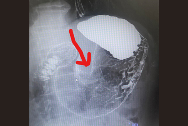消化管造影検査消化器系の検査看護roo! カンゴルー