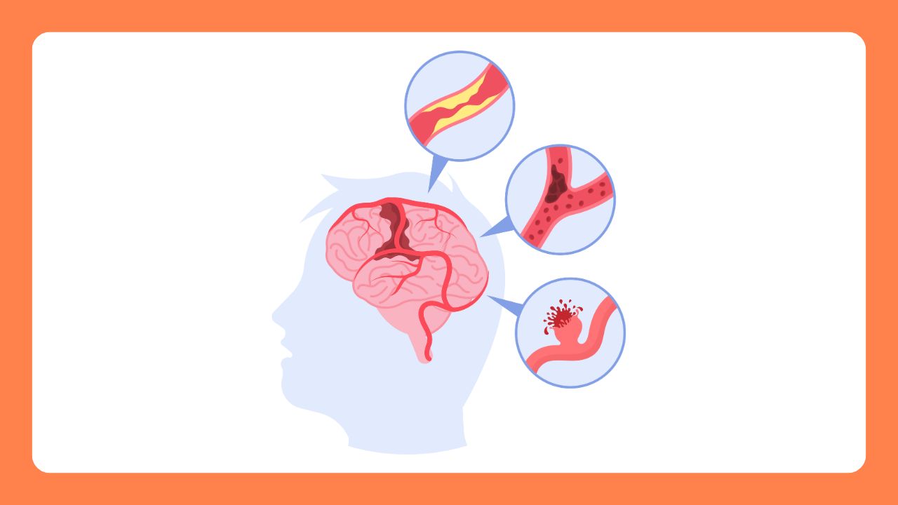ある日突然起こり、人生が変わってしまう『心原性脳塞栓症』
